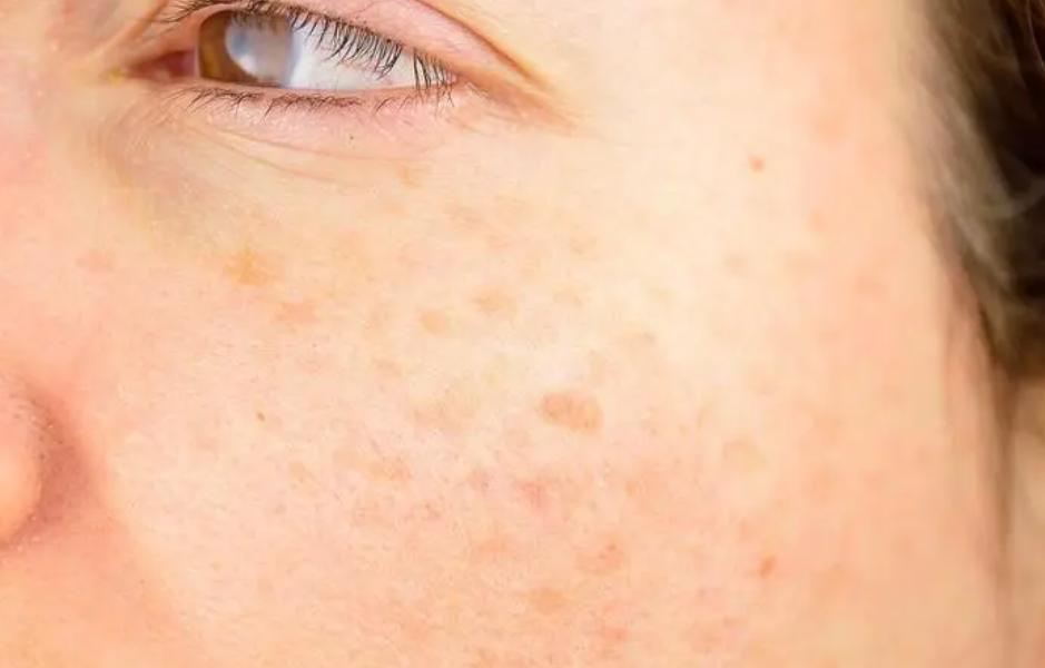 牙膏治疗老年斑小妙招,用生姜和牙膏祛老年斑哪个好