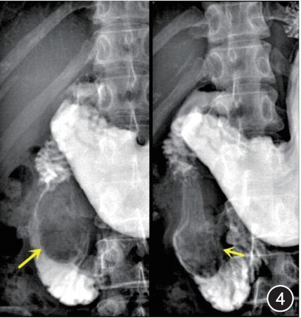急性胰腺炎的病理类型及病变特点,急性化脓性胰腺炎临床表现