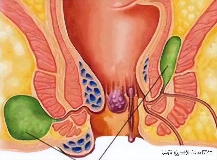 肛周脓肿疼痛难言之隐,突然之间长了个肛周脓肿