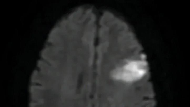 家人突发脑出血咋办？医生教你家庭急救办法，身边有高血压的请看