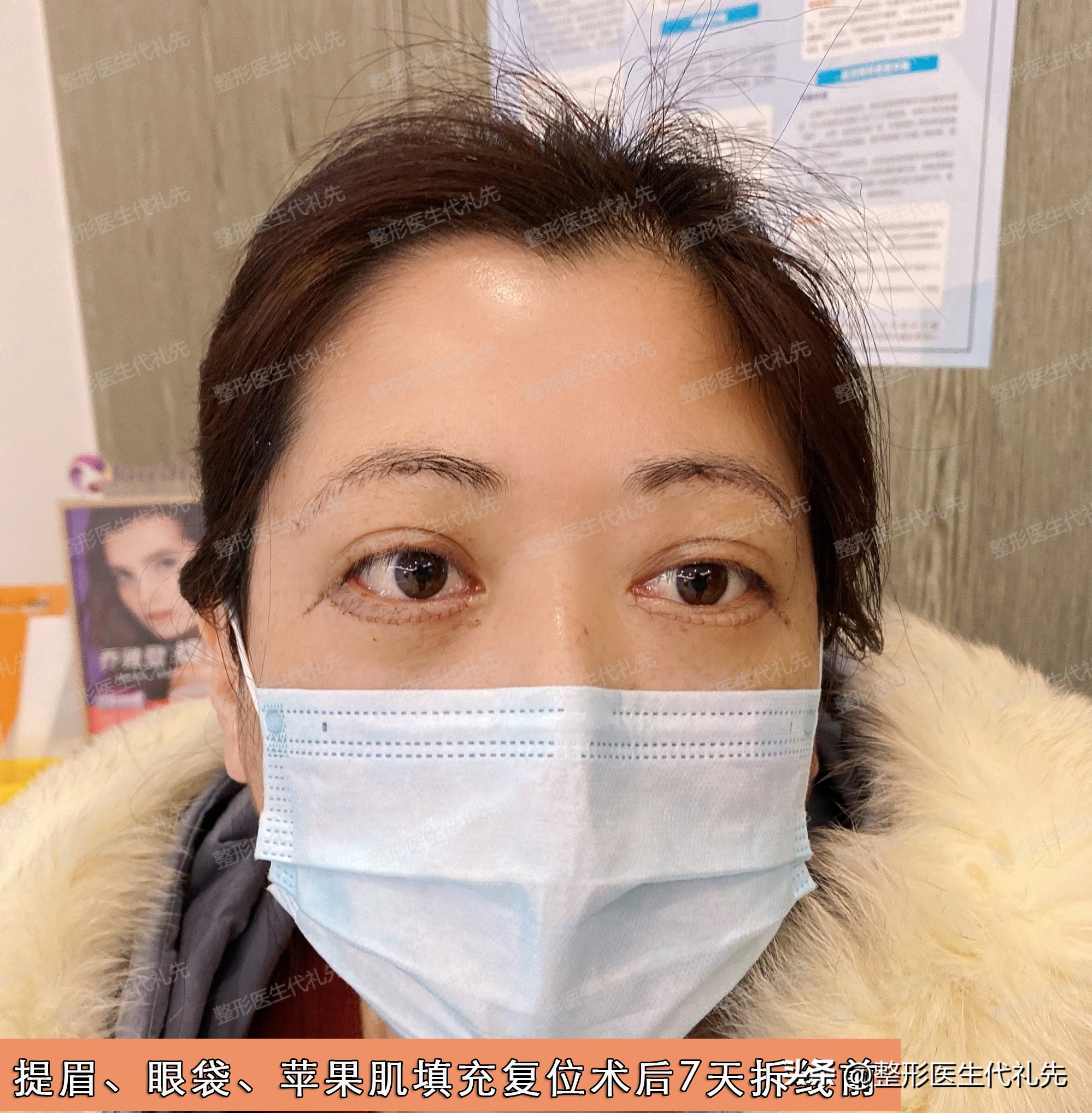 眼袋手术后出现皱纹和凹陷怎么办,祛眼袋手术后凹陷多久恢复好