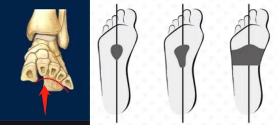 脚趾锤状趾啥意思,脚趾杵状指与正常区别图片