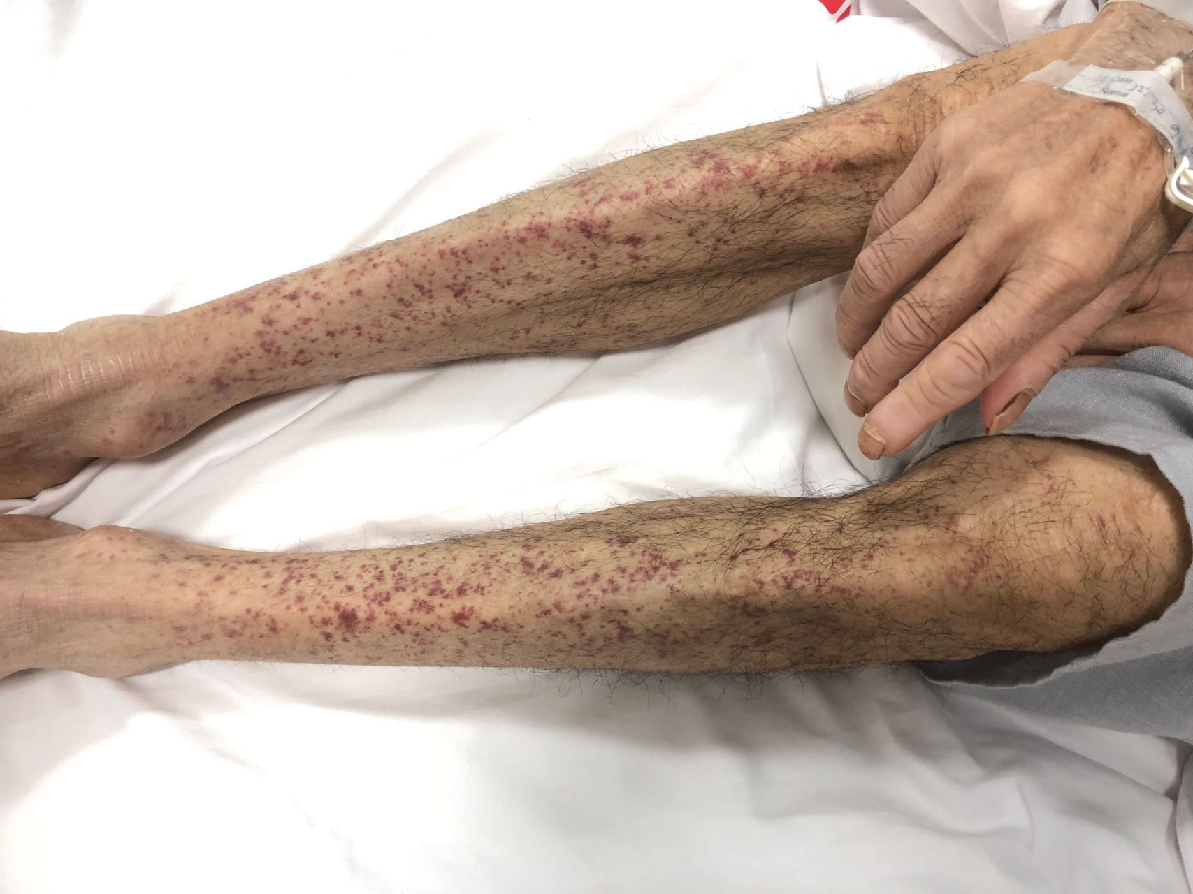 动脉瘤蛛网膜下腔出血术后并发症,动脉瘤导致蛛网膜下腔出血严重吗