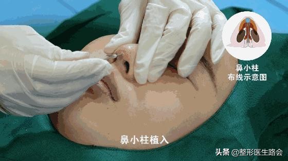 隆鼻三年后可以蹦极嘛,做了隆鼻到底可以蹦极吗