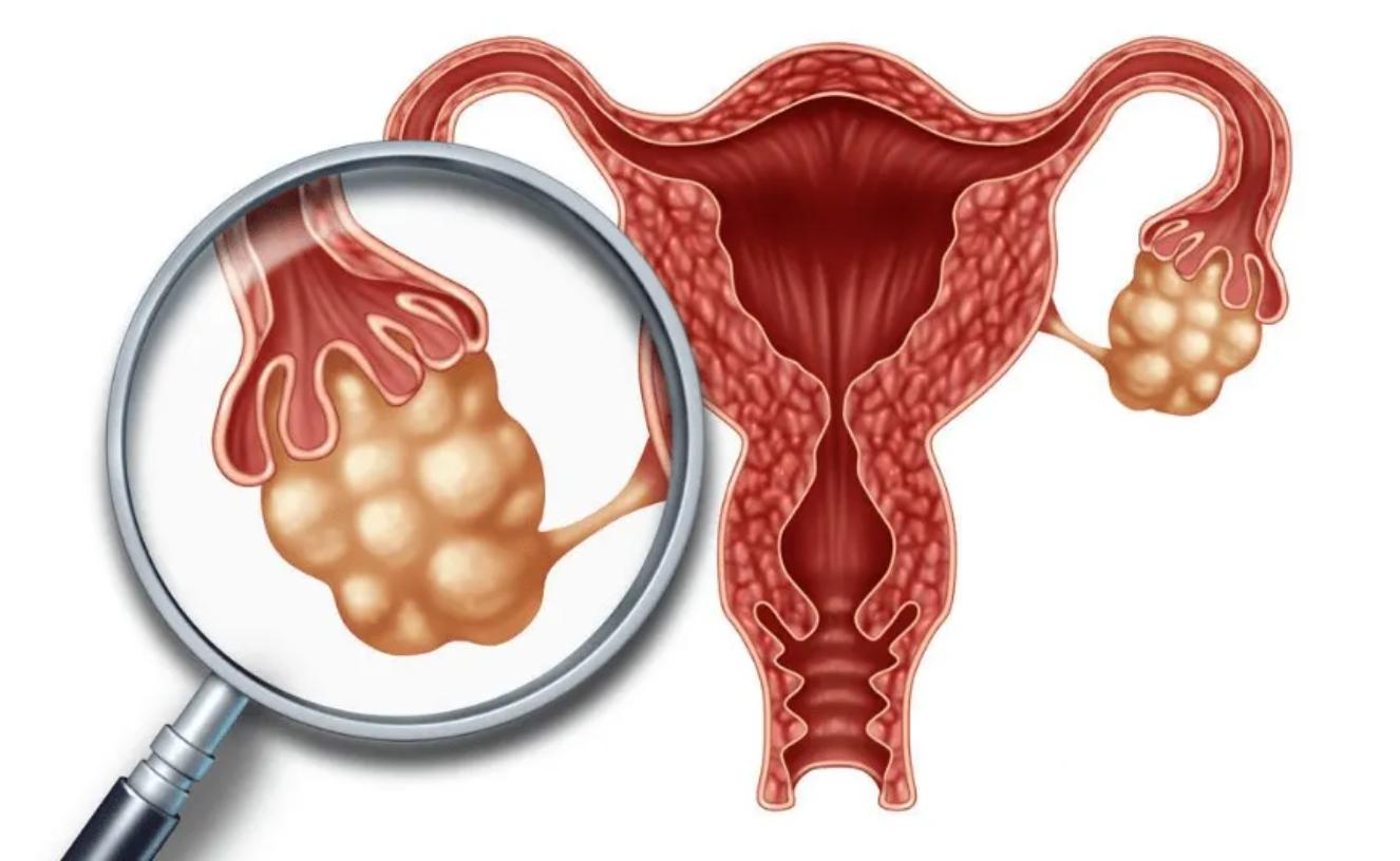会厌囊肿吃中药方子,痰瘀互结证的治法