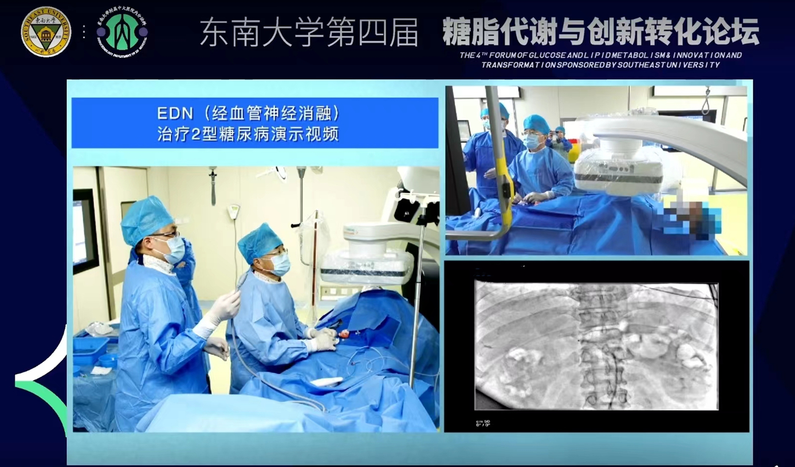 二型糖尿病微创手术普及全国没有,最新一代微创糖尿病手术