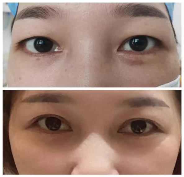 想割双眼皮怕失败,割双眼皮踩雷了应该找医院吗