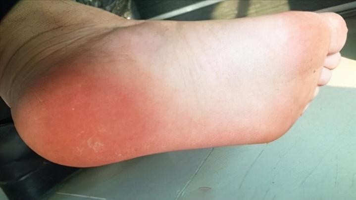 脚底板起茧子走路疼怎么回事,脚底板长茧走路痛咋办