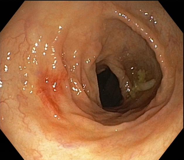 肠道内惊现蜘蛛痣？