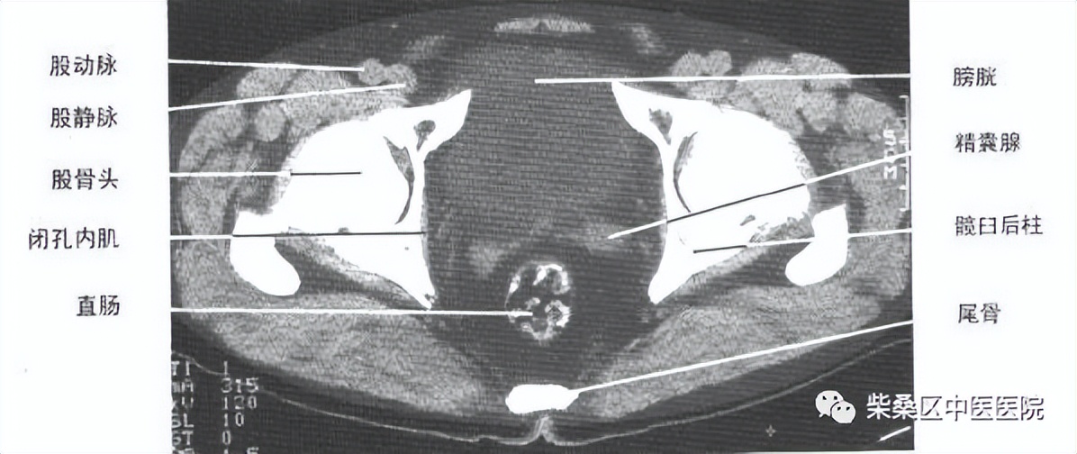 做ct喝水憋尿要多久,喝水憋尿做的尿常规准确吗