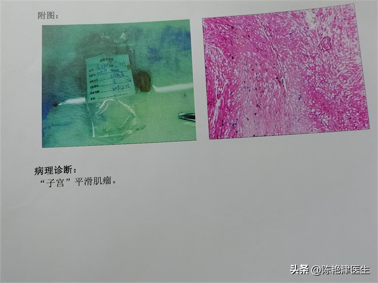 女性为什么容易长子宫肌瘤?提醒:平时尽量避免3个行为,别忽视