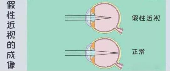 近视防控的科普类短视频怎么做,反转拍预防近视