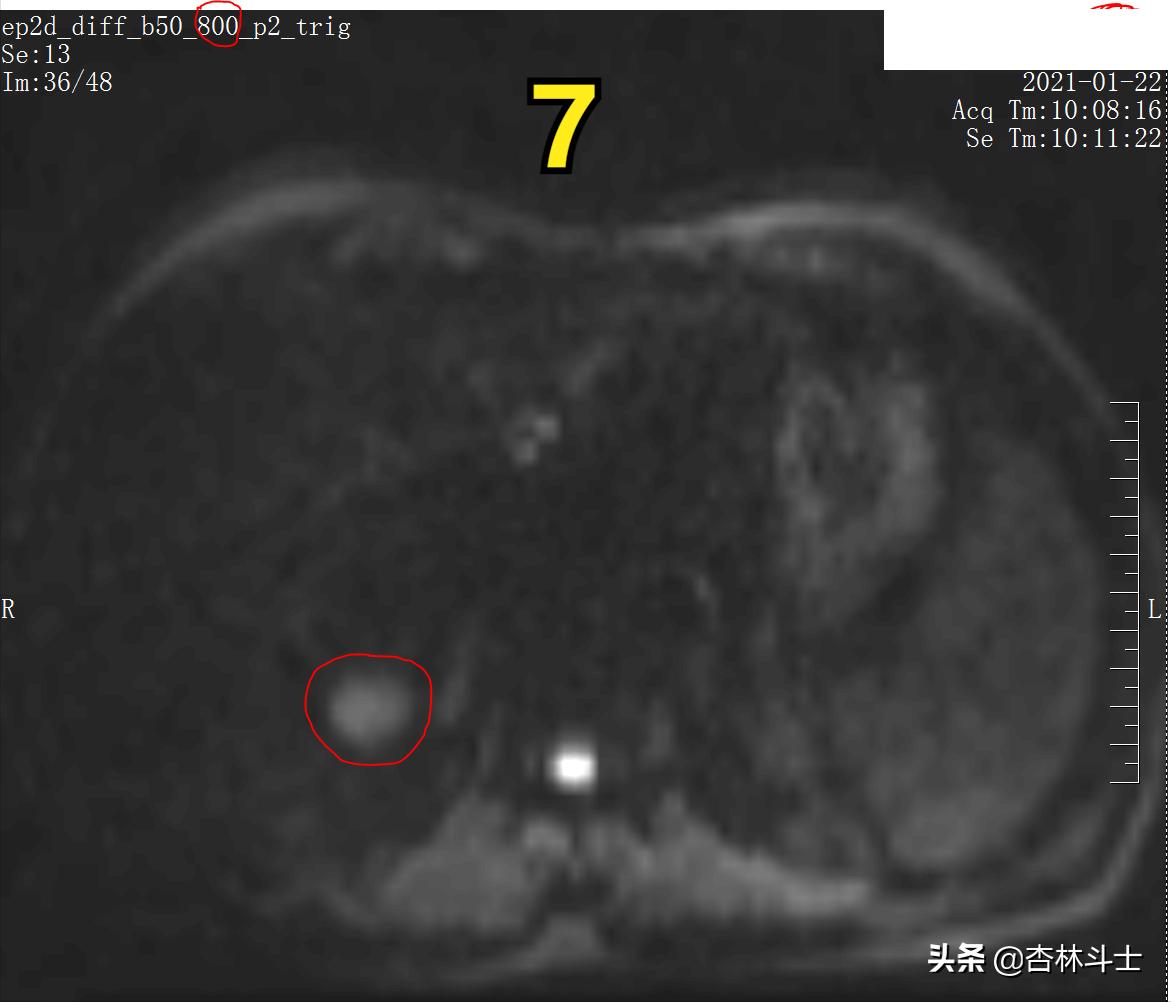 肝癌8公分肿瘤能活多久,肝癌细胞最大长多大