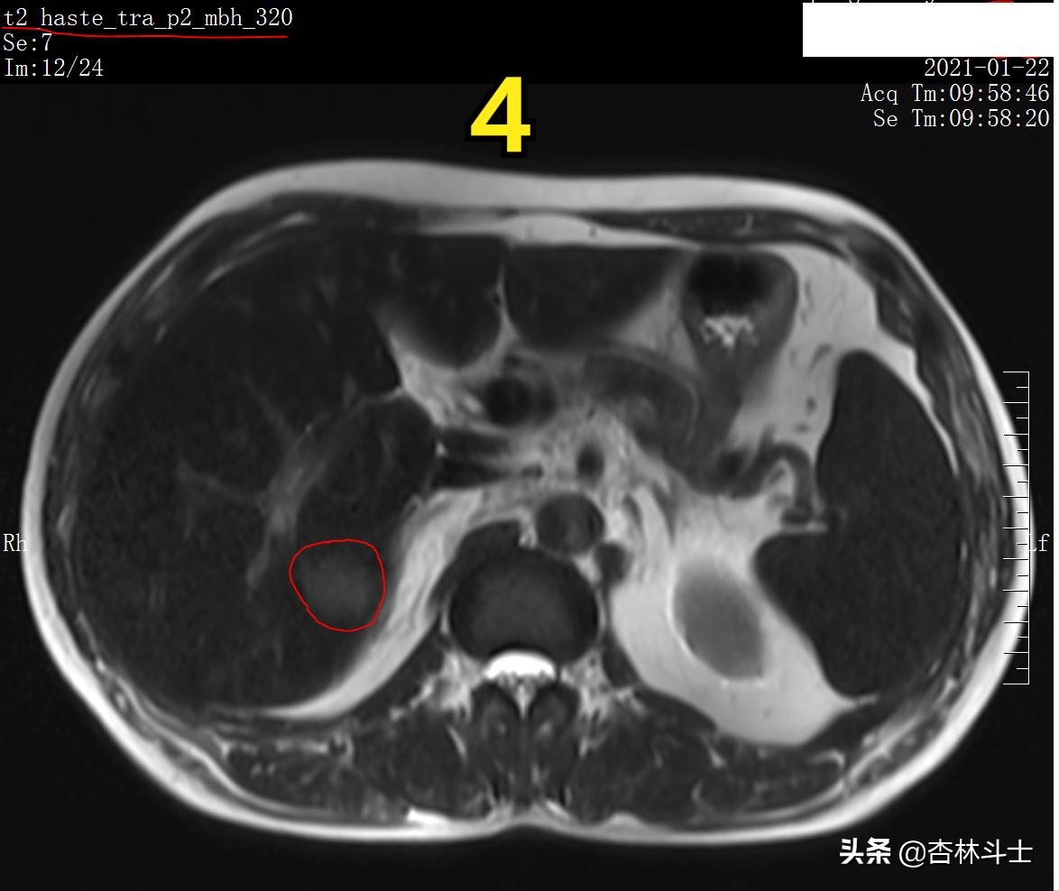 肝癌8公分肿瘤能活多久,肝癌细胞最大长多大
