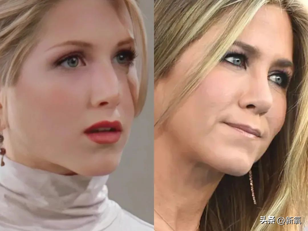 嘴唇薄变丰满,嘴唇变凸变丑怎么办