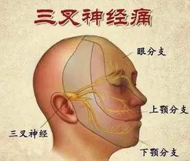 治疗三叉神经痛首选的药物是,老年人三叉神经痛怎么回事