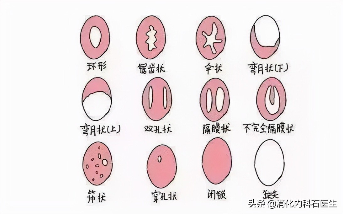 12岁女孩肚子疼是肠痉挛引起的吗,女孩11岁肚子疼肠痉挛怎么回事