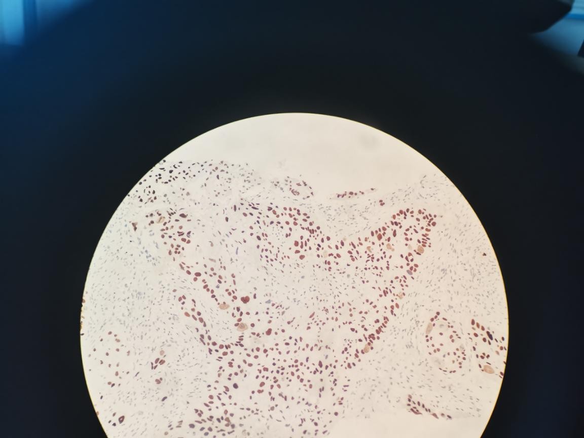 HPV感染和宫颈癌的预防与早期发现