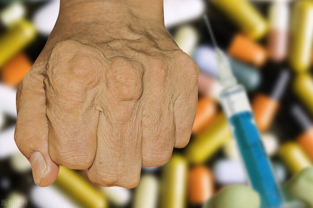 为什么会有老人斑长出来了,为什么老人会长老人斑