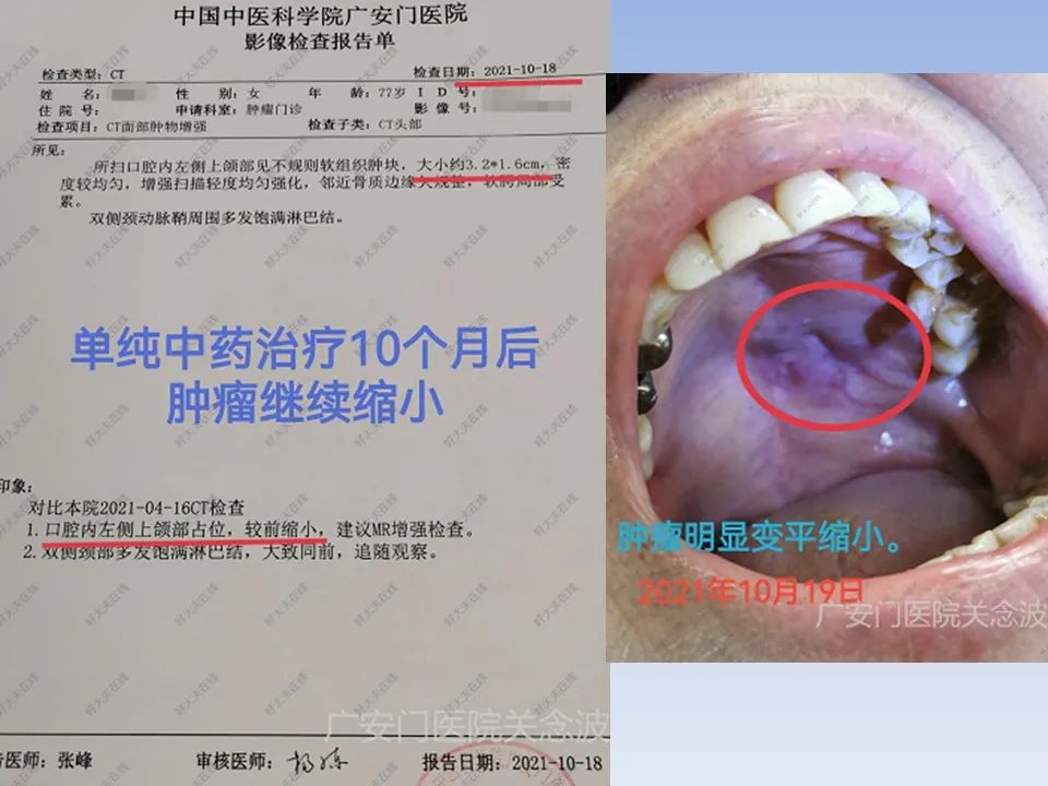 正确使用中医药治疗肿瘤才显效,关于中医中药在肿瘤治疗中的见解