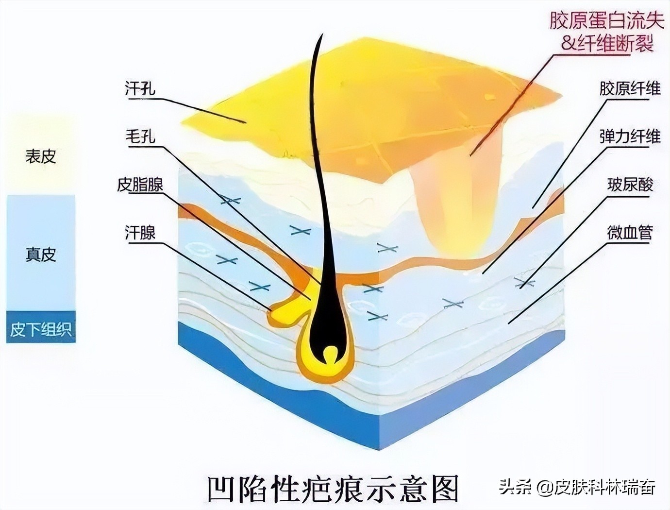 让凹陷性疤痕长平的家庭小妙招,上海治疗凹陷性疤痕哪个医院好