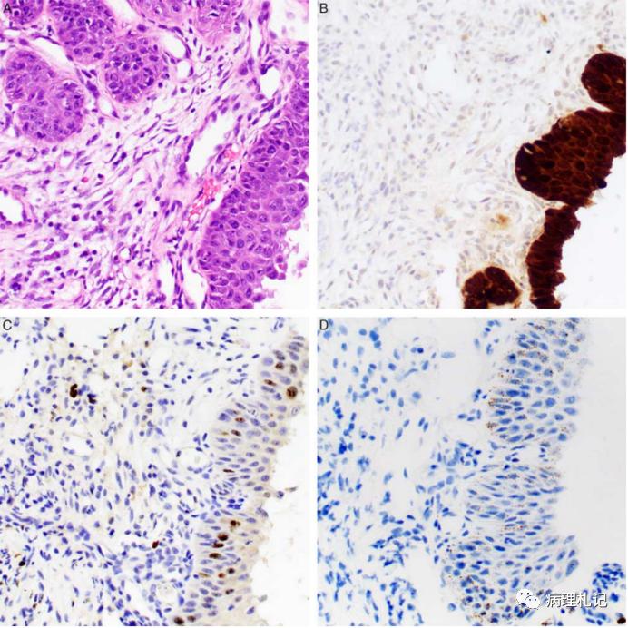 宫颈病理免疫组化p16是什么意思,p16阳性低度上皮病变严重吗