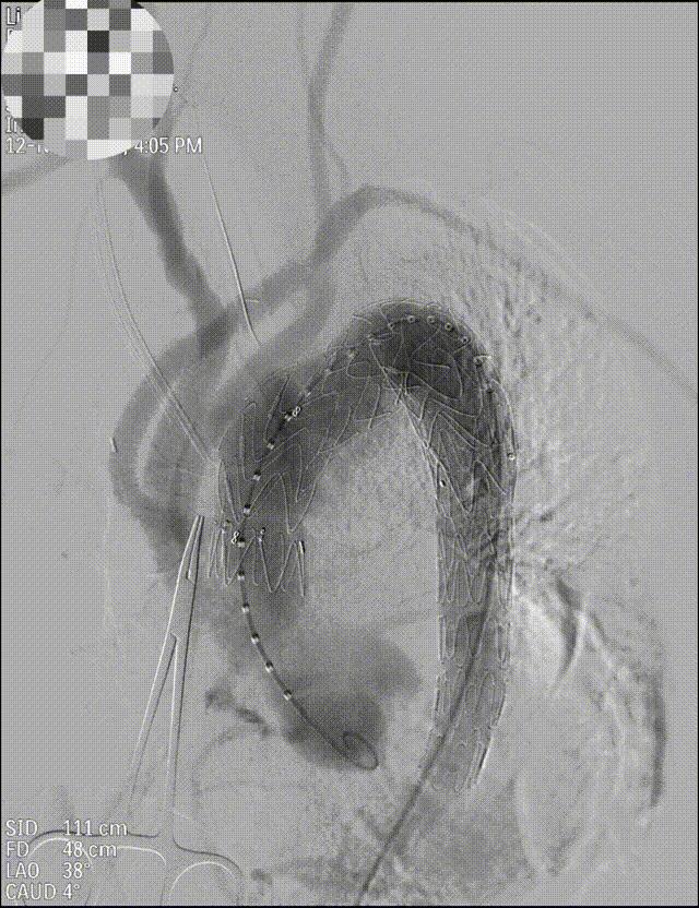 主动脉夹层动脉瘤的超声表现,主动脉夹层动脉瘤会左脚痛吗