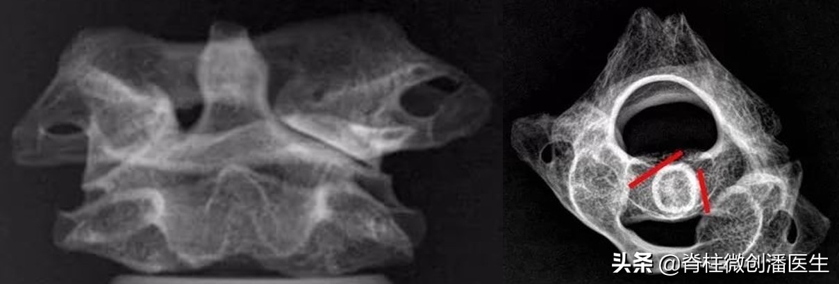 宝宝脖子右歪应该往哪看,百天宝宝脖子光往一边歪