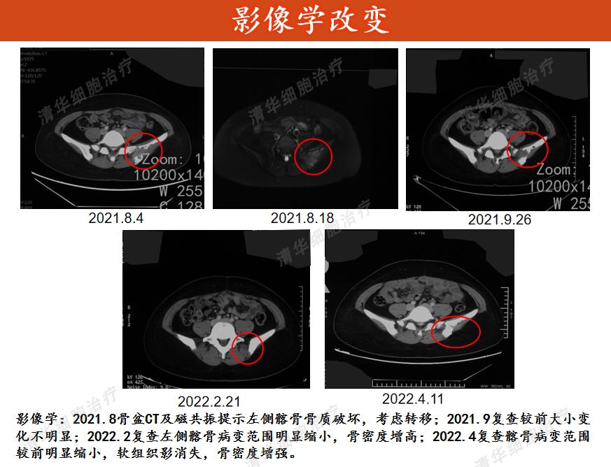 晚期肺癌脑转移，这位年轻女性患者的治疗方案，你可以看看