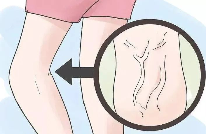 中医治静脉曲张的妙招,静脉曲张的中医疗法的文章