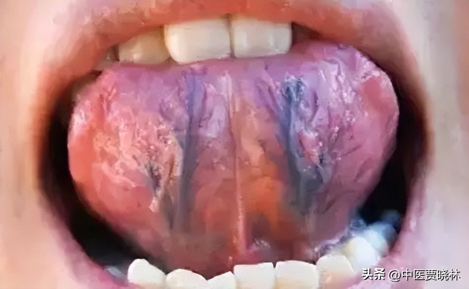 唇紫的中药调理,舌底暗紫有瘀斑中药方