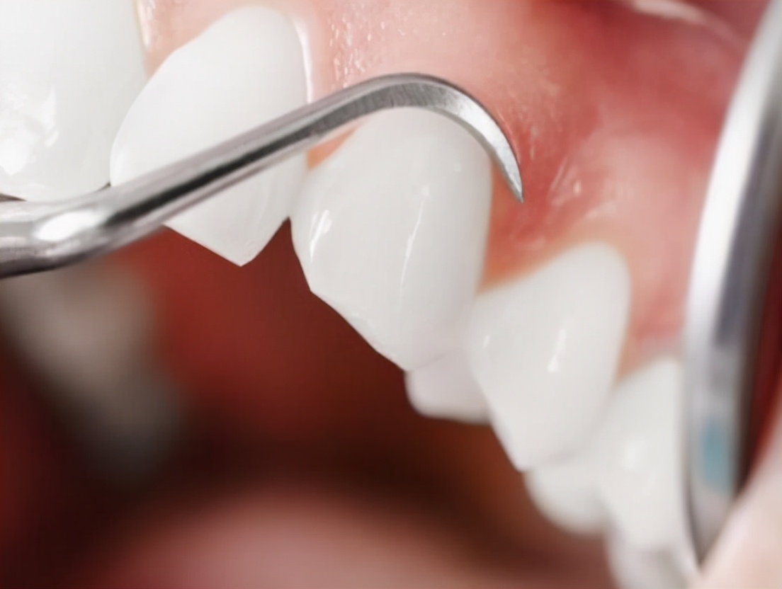 甲硝唑相当功效的药,阿莫西林加甲硝唑可以治疗什么病