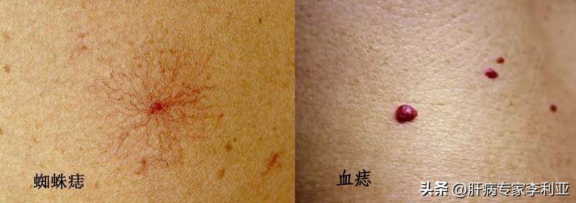 肝癌征兆身上长痘吗,肝癌脸上长痘痘怎么回事