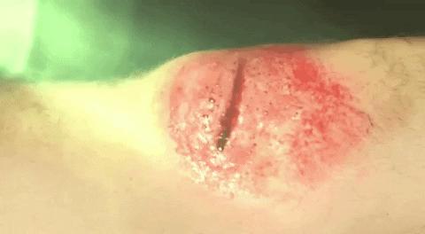 全球干细胞最新临床进展,干细胞再生医学现状