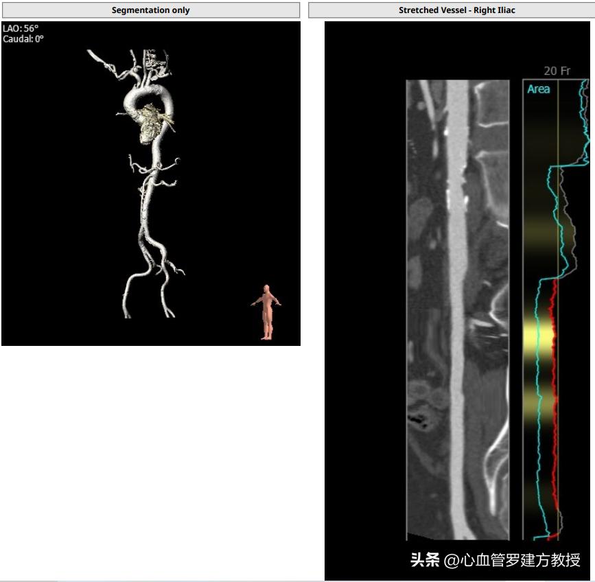 主动脉瓣狭窄的典型三联征表现,主动脉瓣狭窄治疗新技术