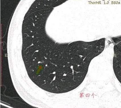 因癌症去世的妈妈,母亲肺癌子女查出磨玻璃结节