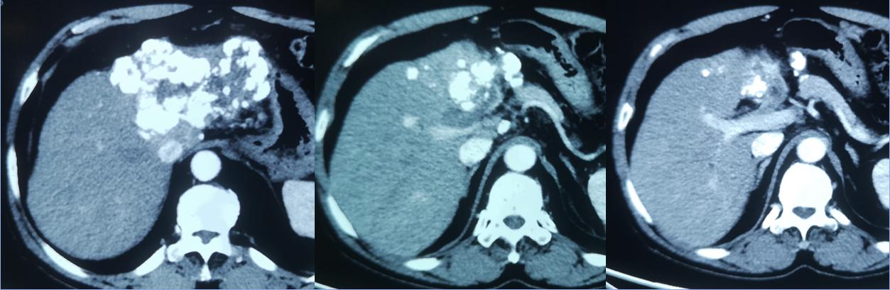 手术治疗癌症会好吗,手术介入化疗效果