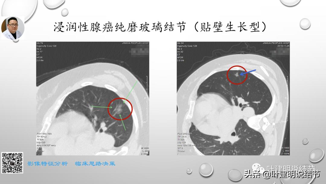在《一脉阳光》呼吸影像诊断专题培训班上的讲课PPT（第一部分）
