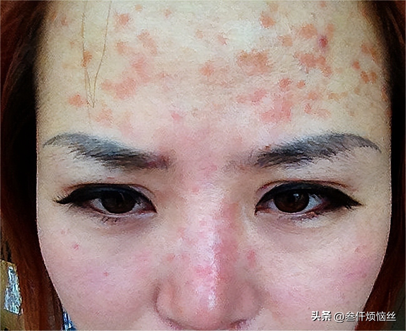 头发过敏用什么染发剂,染发剂过敏的一个现象