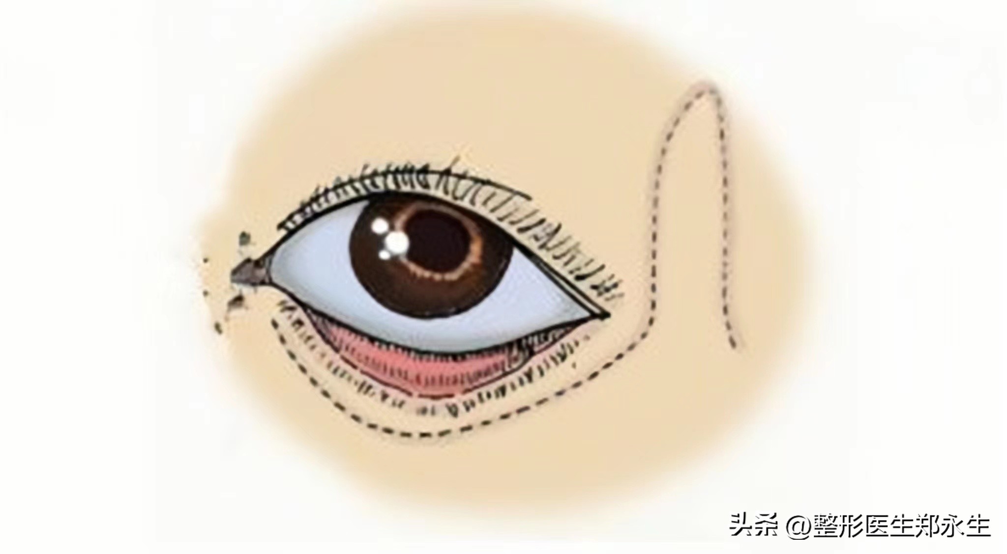 下眼睑凹陷眼睛后退,哪种情况属于眼睑外翻