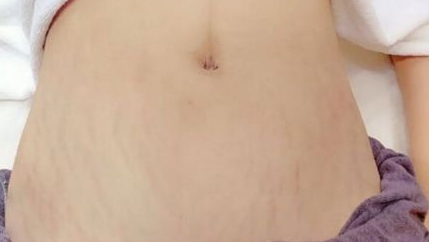 产后如何淡化妊娠纹一个妙招,产后淡化妊娠纹最有效的方法