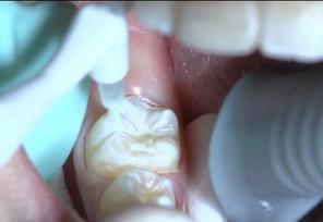 几岁到几岁适合做窝沟封闭,长大了还可以做窝沟封闭吗