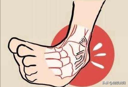 体育保健学崴脚急救措施,崴脚康复后怎么加强预防
