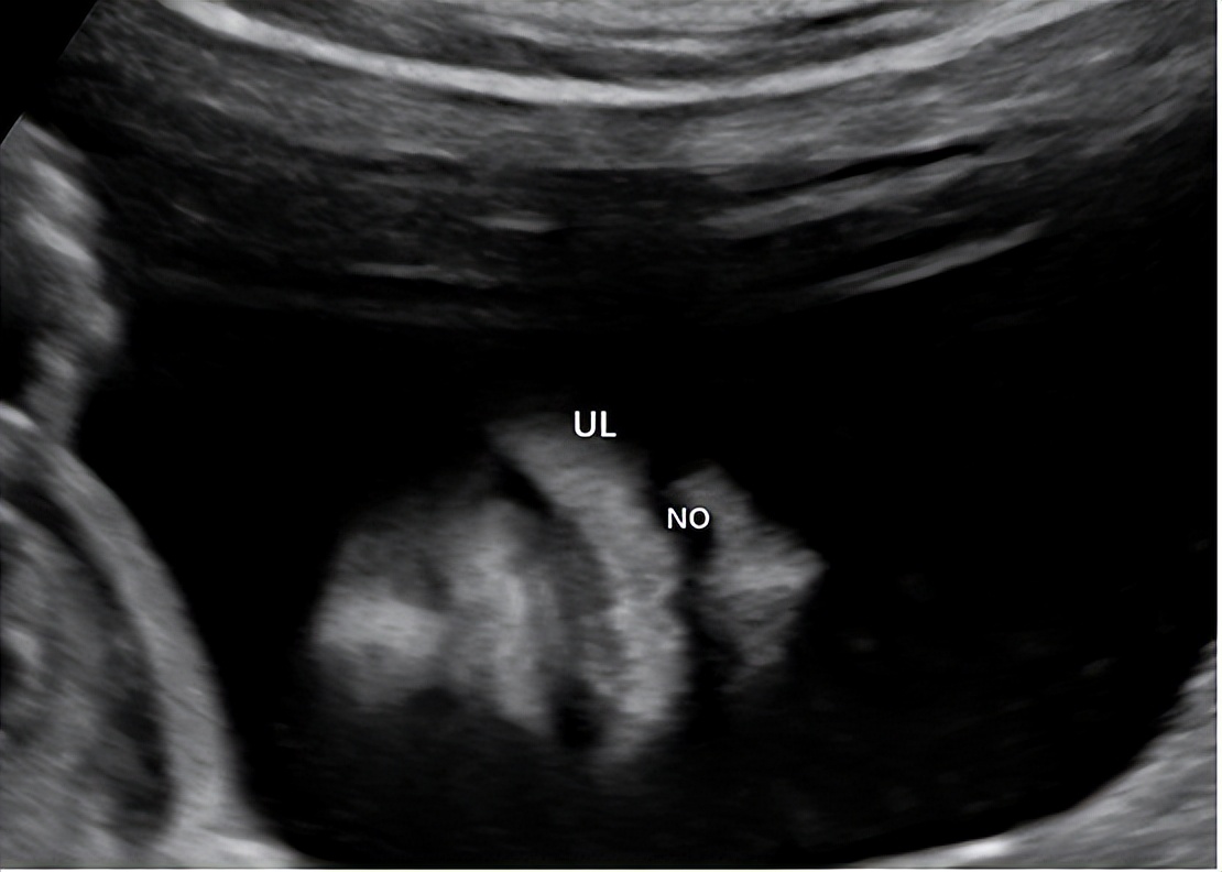 2022年产前超声筛查指南,胎儿超声异常的产前诊断