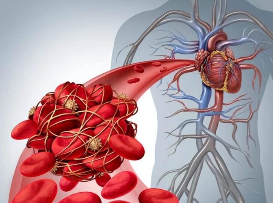 胆固醇升高身体要遭殃？教你4招，击退高血脂，平稳胆固醇