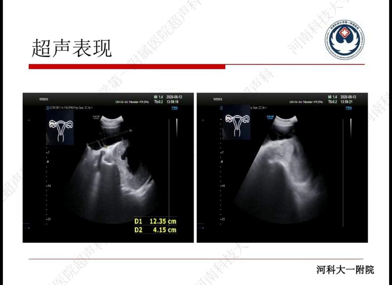 下腹疼痛原因及其治疗,下腹部疼痛持续一年了