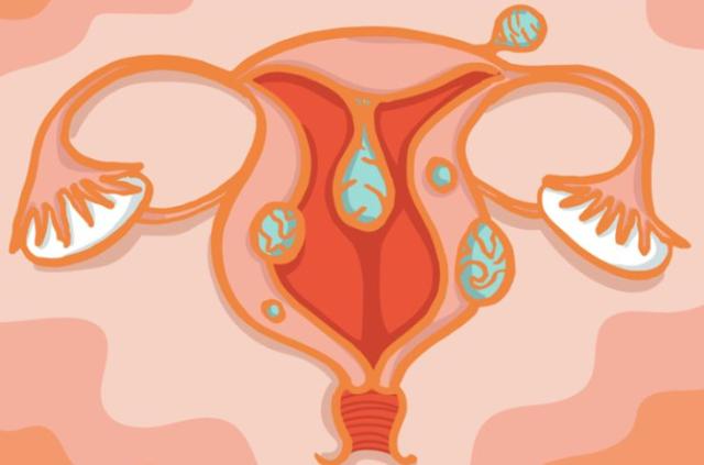 子宫肌瘤可以吃辣菜椒吗,子宫肌瘤可以吃辣肠吗