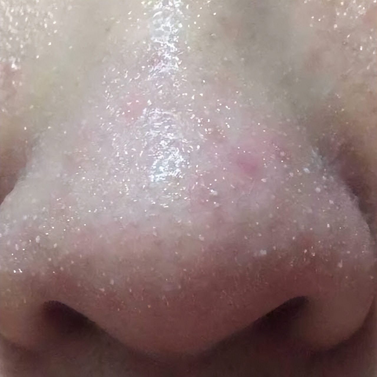 真黑头假黑头傻傻分不清楚，怎么去黑头？