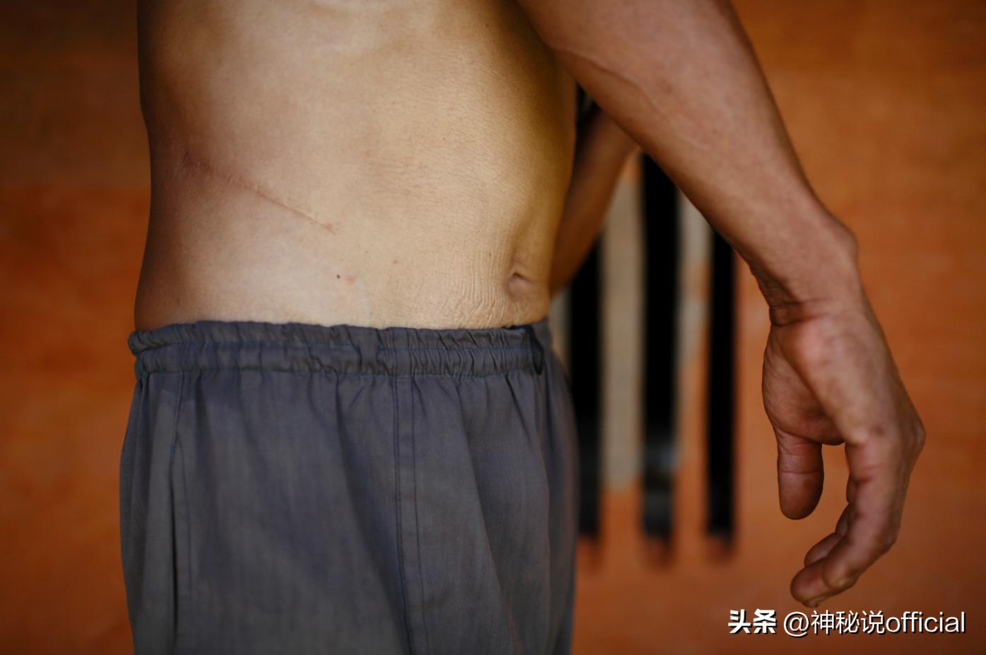 尼泊尔“卖肾村”，穷人以“高价”500美元出售，放到*市黑**上交易