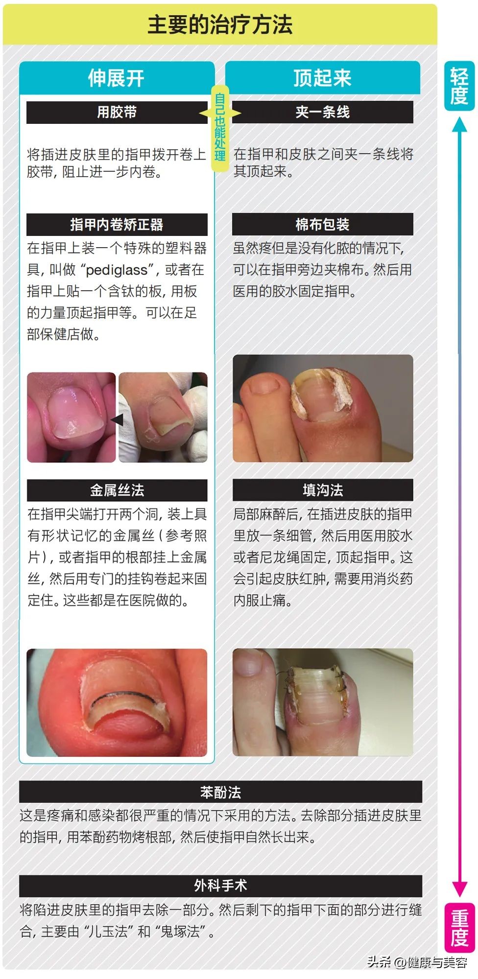 指甲卷曲内卷,指甲卷曲用什么药